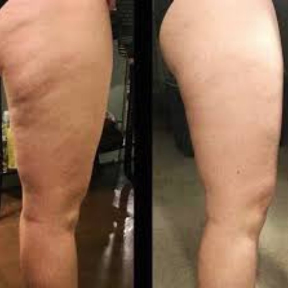 Cellulite Lotion - Picture 2 of 2
